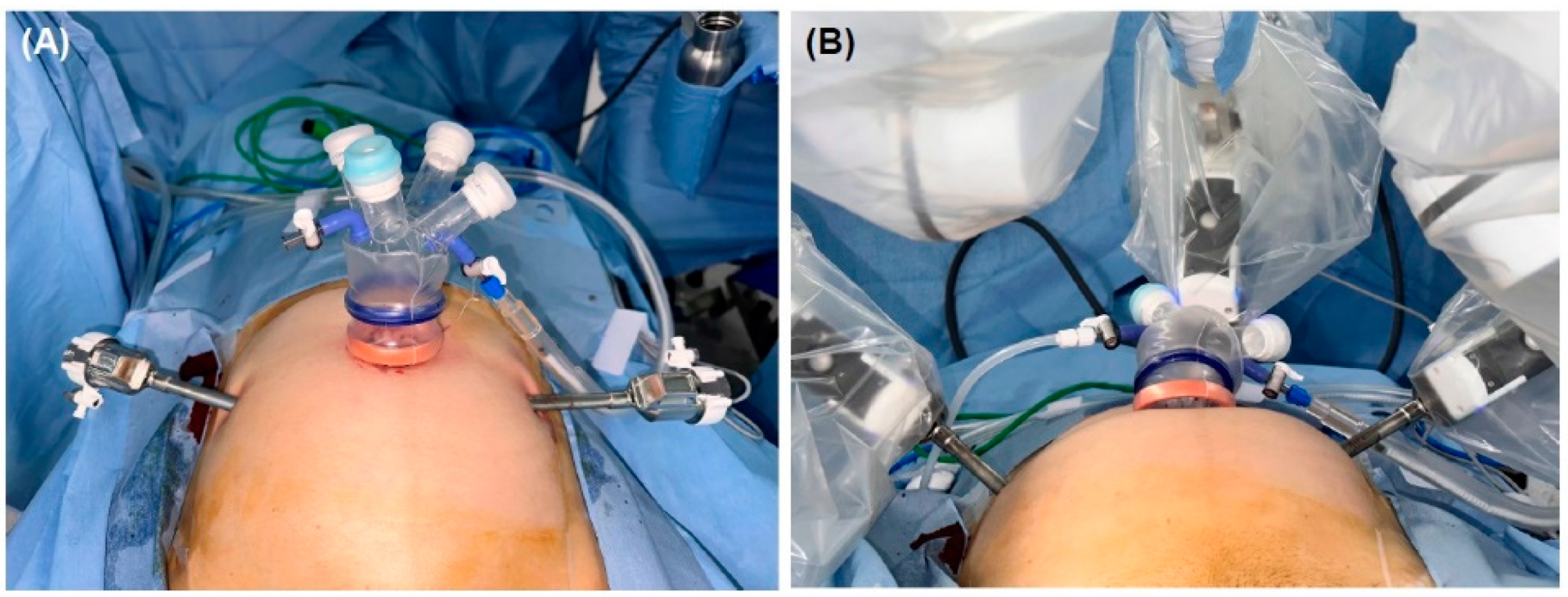 Robotic Uterus Removal Surgery in Mohali